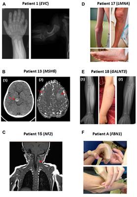 Clinical impact of exome sequencing in the setting of a general pediatric ward for hospitalized children with suspected genetic disorders